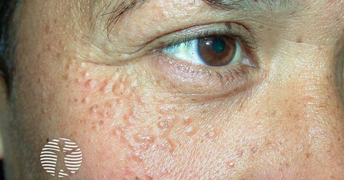 Clinical image of Syringoma