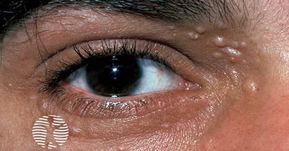 Clinical image of Trichoepithelioma