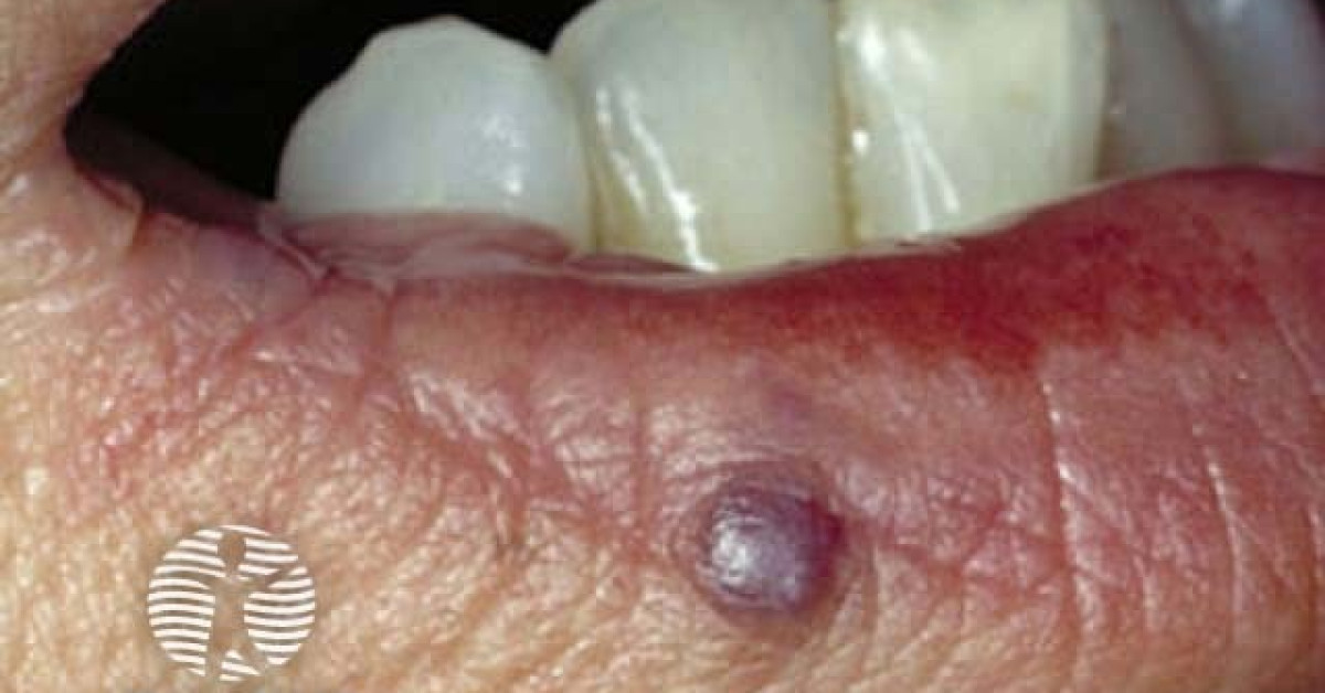 Clinical image of Venous lake