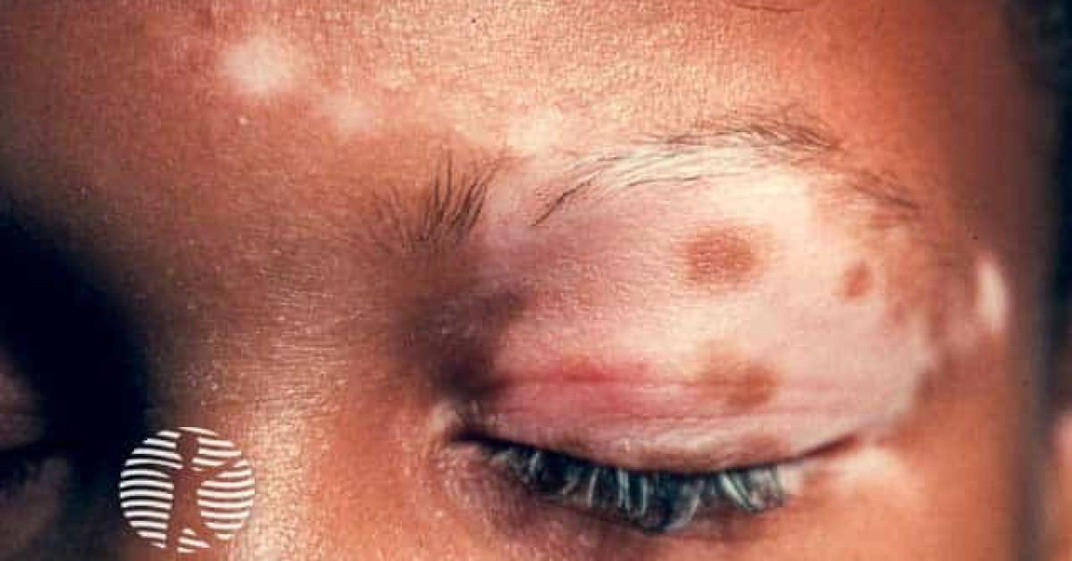 Clinical image of Vitiligo