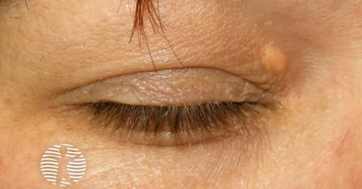 Clinical image of Xanthelasma palpebrarum