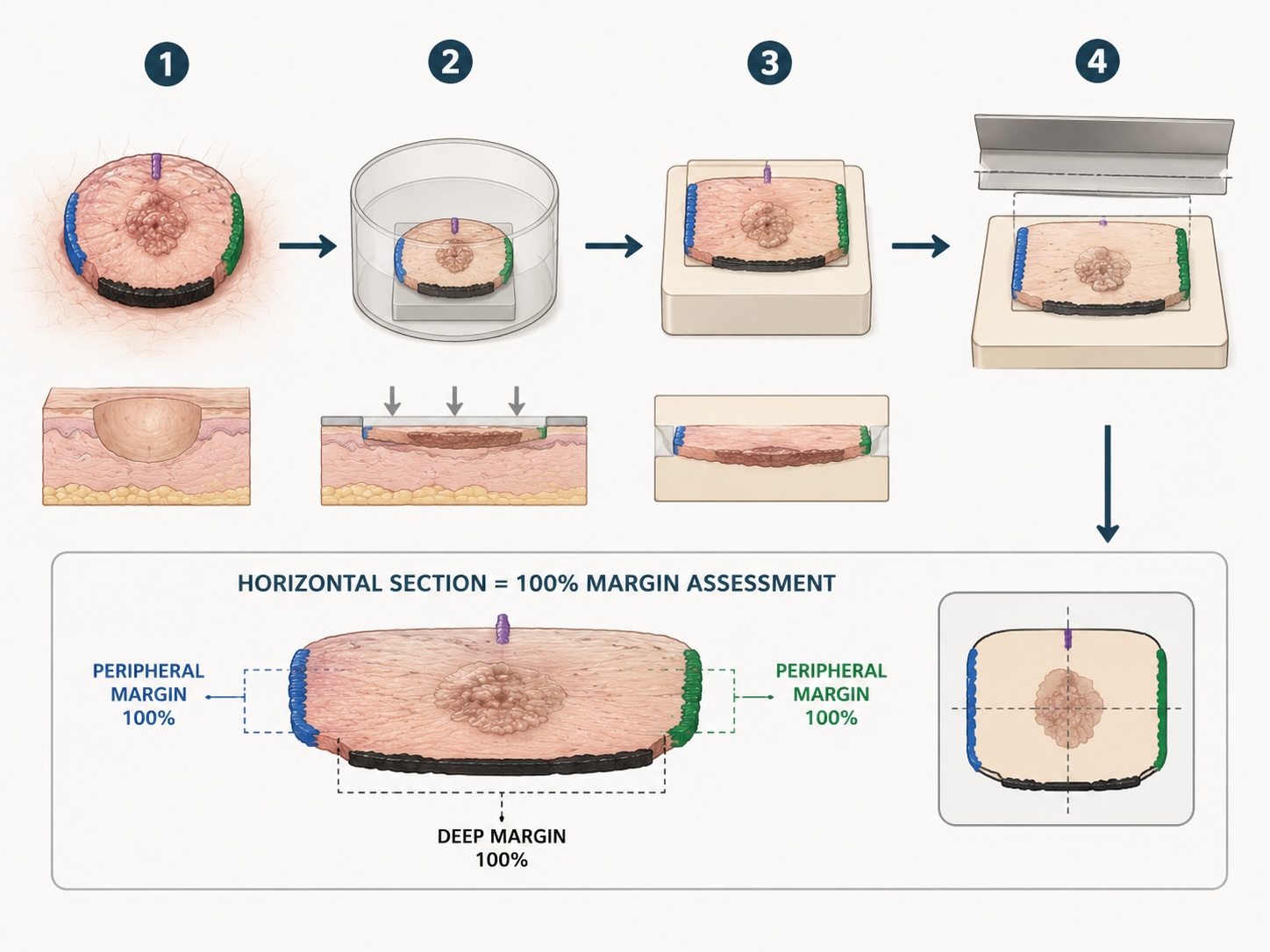Mohs technique โ horizontal sectioning
