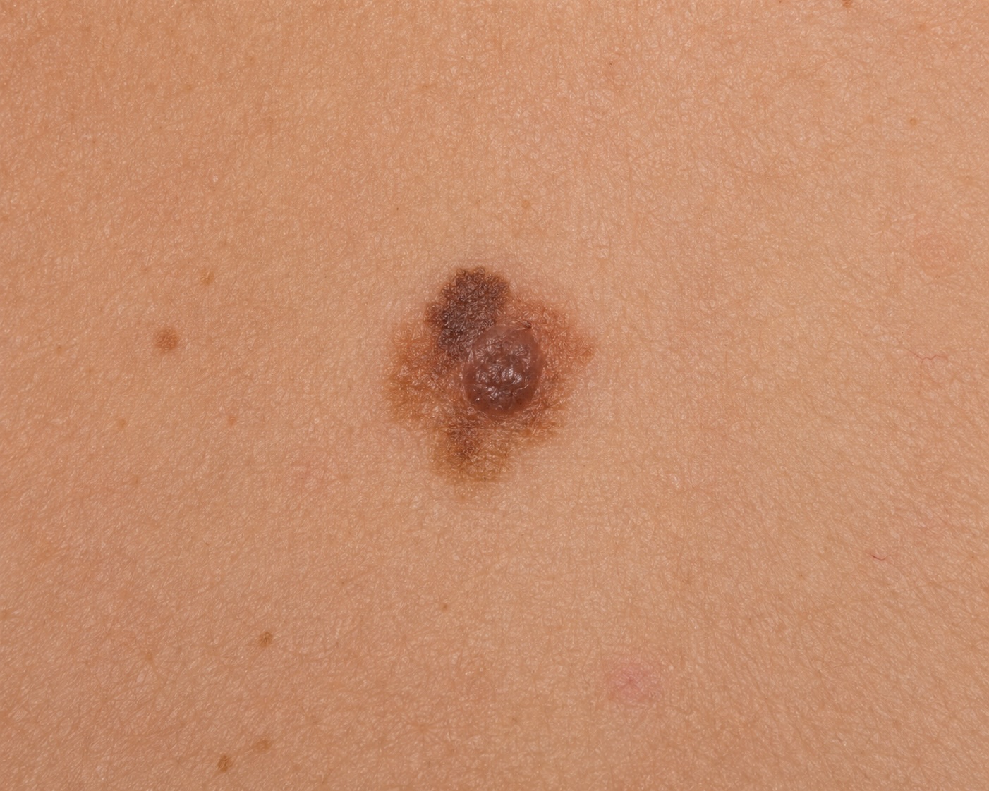 Atypical naevus, back
