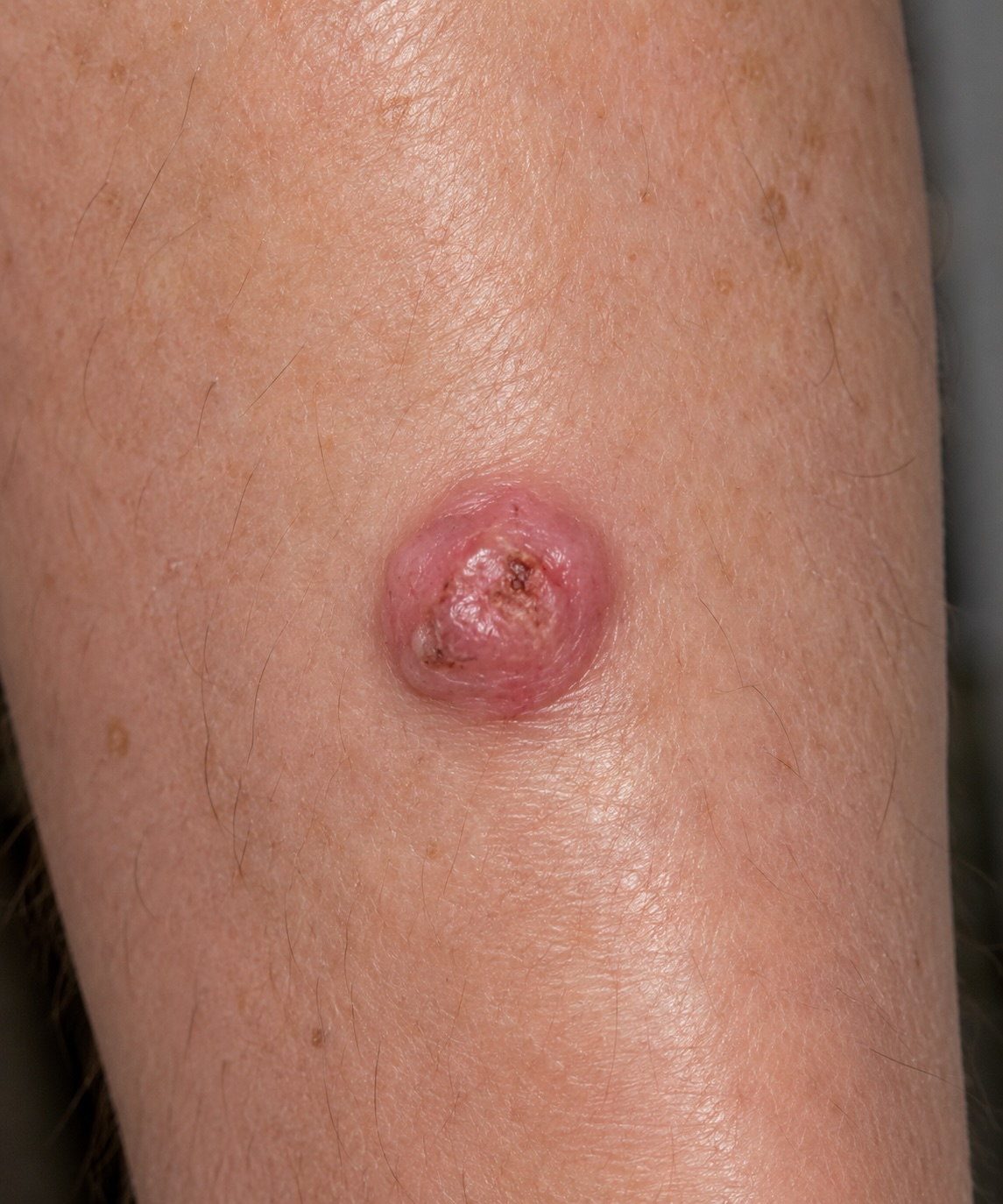 Amelanotic melanoma, leg