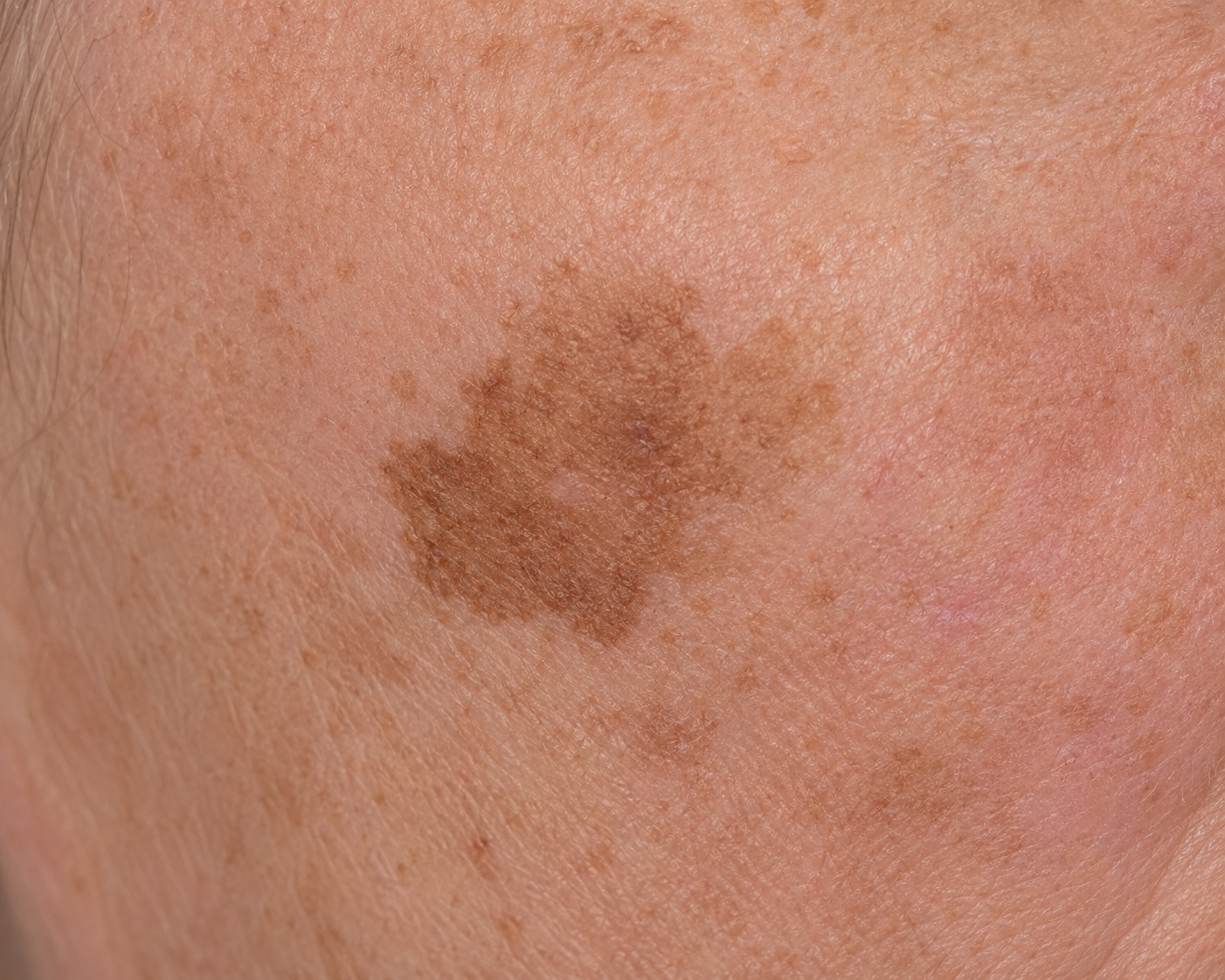 Lentigo maligna melanoma, cheek, Fitz I