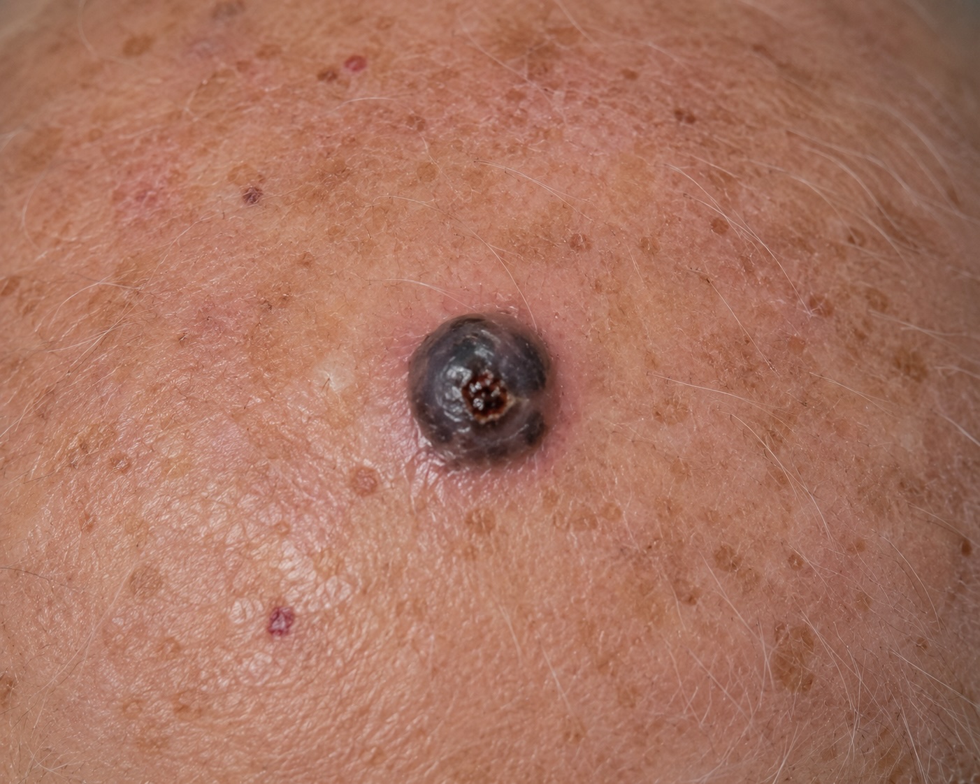 Nodular melanoma, scalp, Fitz II