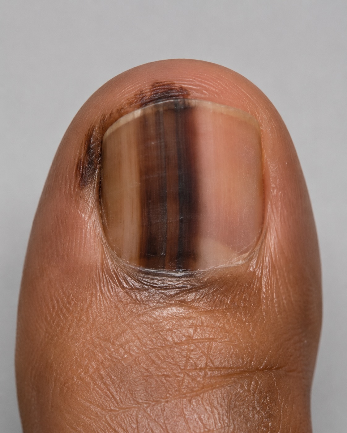 Subungual melanoma + Hutchinson sign
