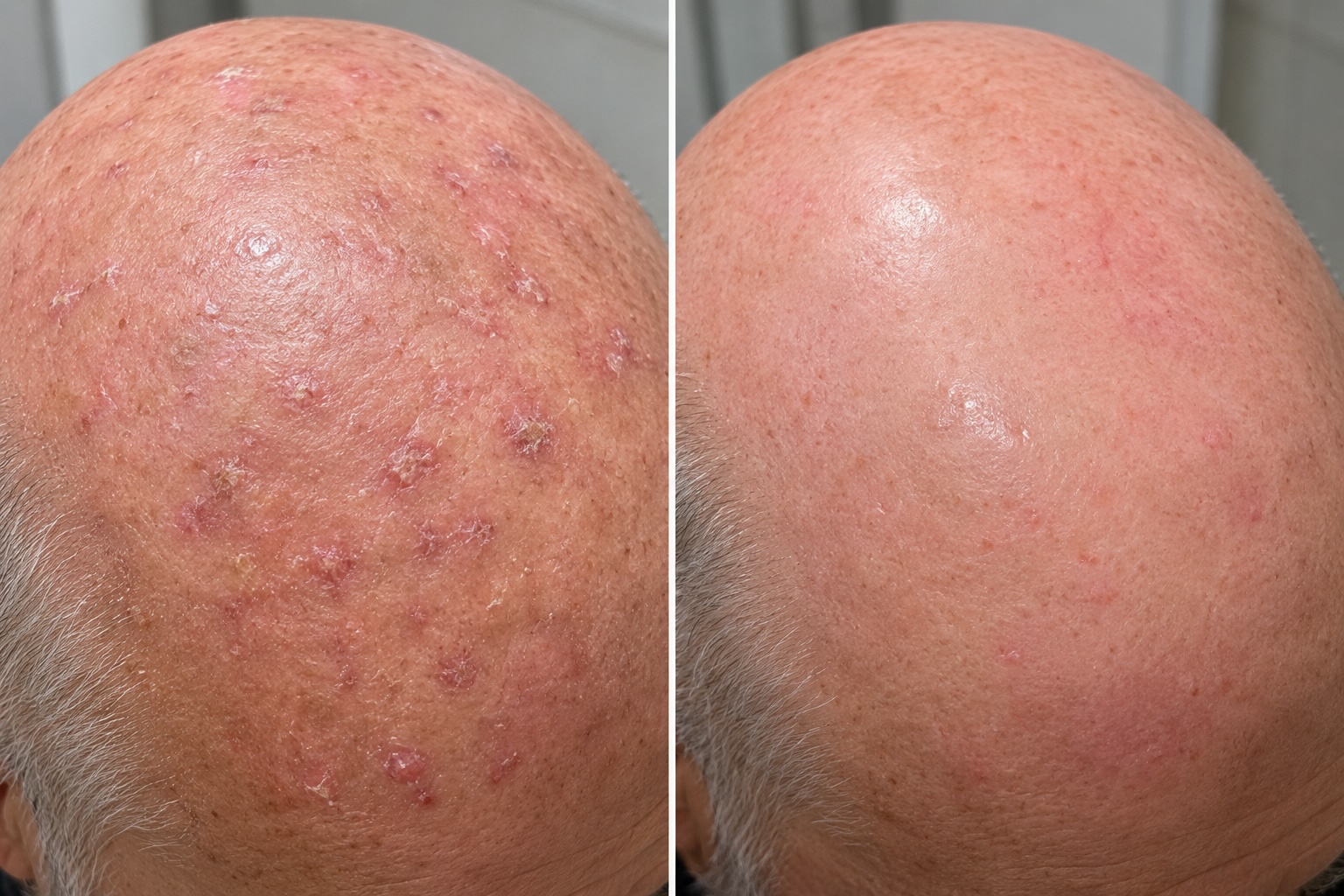 Field AK before/after PDT